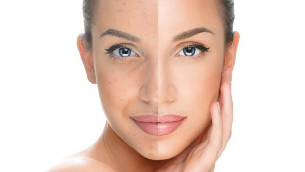 Unique Clinic Face-Pigmentation